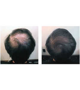 HAIR FORCE ONE LOSION - Ubrzava rast kose 150 ml